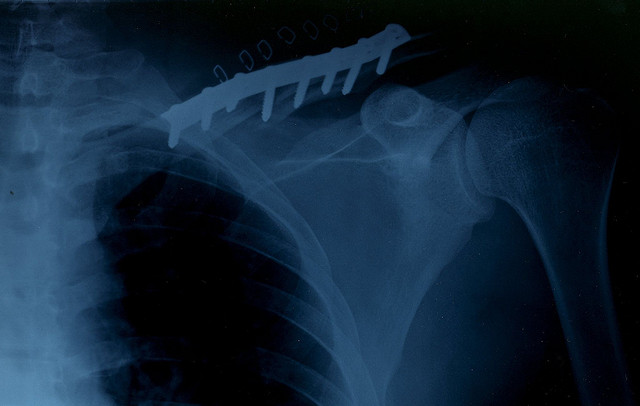 Bouncing Back From A Broken Collar Bone